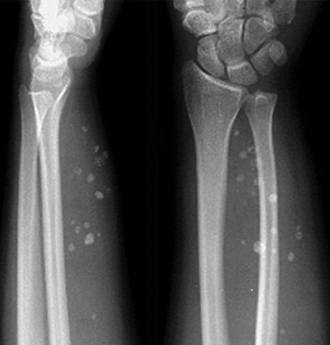 Can a fracture or injury cause sarcoma? 2022