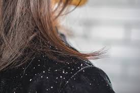 Three ways to quickly get rid of dandruff at home